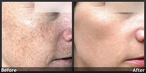 Planet Eden 70% Glycolic Acid Skin Peel with Free Fan Brush- Unbuffered Professional Grade - الصورة 5
