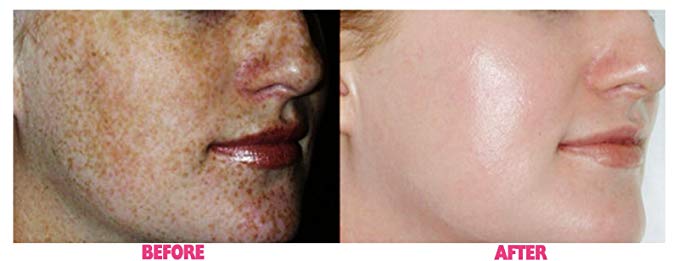 Planet Eden 70% Glycolic Acid Skin Peel with Free Fan Brush- Unbuffered Professional Grade - الصورة 3