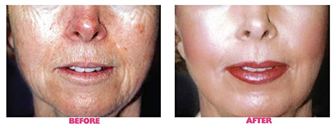 Planet Eden Intense Repair 88% Lactic Acid Skin Peel with Free Fan Brush - Unbuffered Professional Grade - Revive Sun Damaged Skin Quickly - Image 2