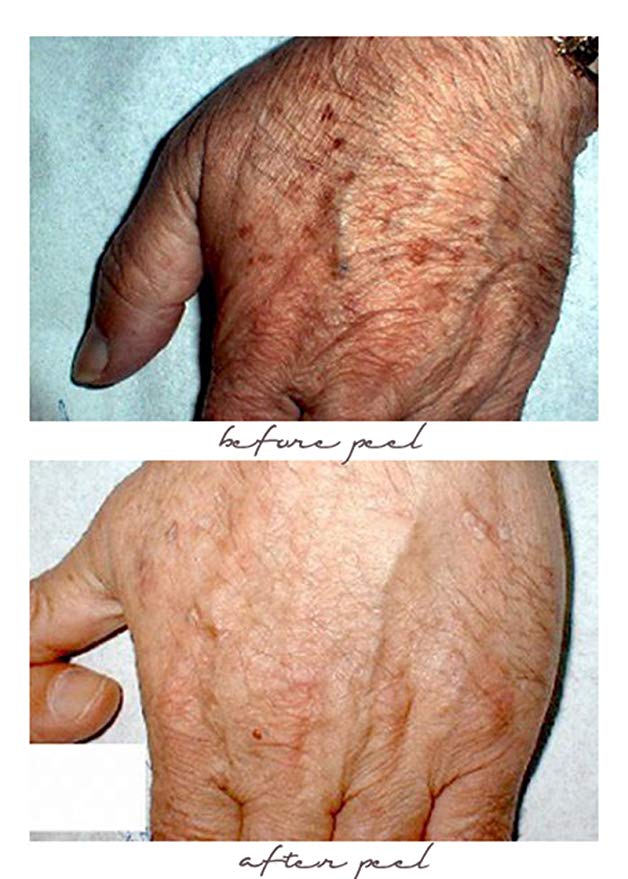 Planet Eden 70% Glycolic Acid Skin Peel with Free Fan Brush- Unbuffered Professional Grade - الصورة 2